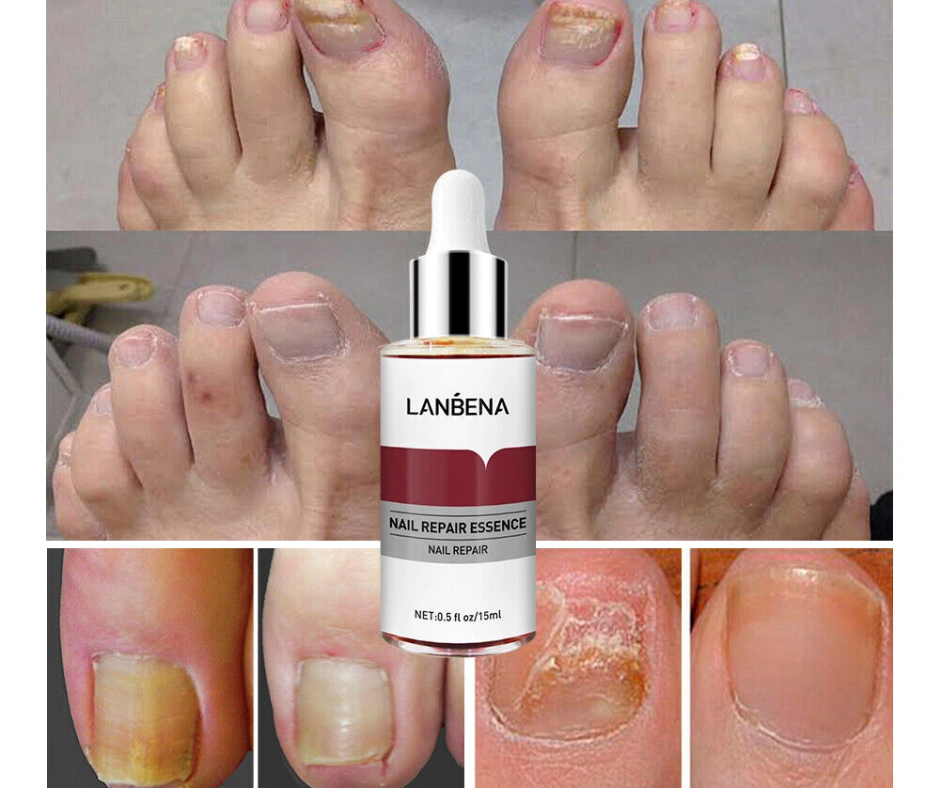 LANBENA NAIL REPAIR ESSENCE
